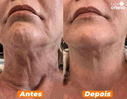 HoneySkin® - Oléo Rejuvenescedor e Redutor de Papada (100% MEL PURO)