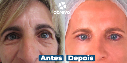 OpenEyes - Creme Reparador Rápido de Olhos (Elimina Rugas, Bolsas e Olheiras)