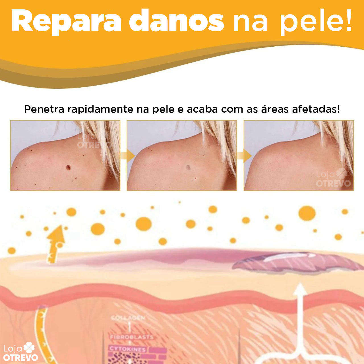 BeeTag - Spray Removedor Instantâneo de Verrugas e Sinais da Pele (EFEITO IMEDIATO)