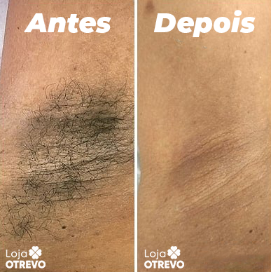 Mini Depilador Portátil Com 5 Super Laminas Clareadoras ( COMPRE 1 e LEVE 2) - DepiGirl®