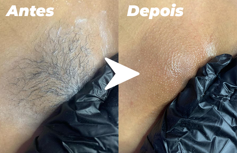 Mini Depilador Portátil Com 5 Super Laminas Clareadoras ( COMPRE 1 e LEVE 2) - DepiGirl®